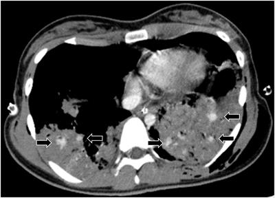 Blush in Lung Contusions Is Not Rare and Has a High Risk of Mortality in Patients With Blunt Chest Trauma